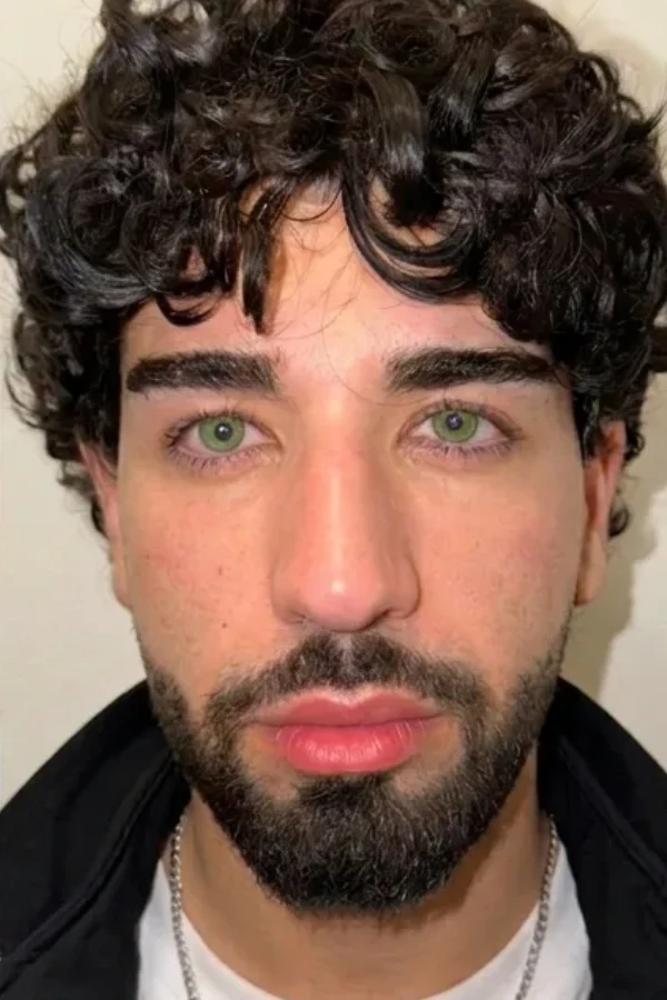 Resultat keratopigmentation apres
