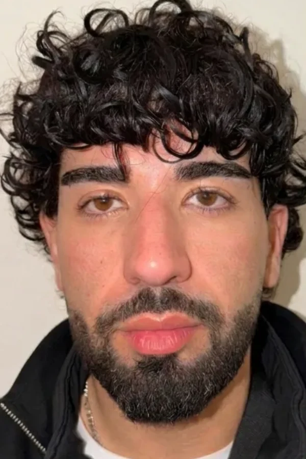 Resultat keratopigmentation avant