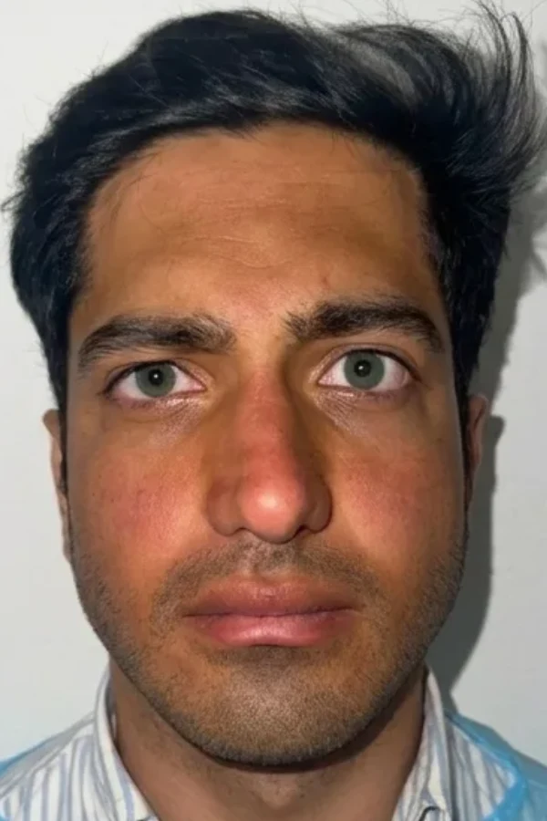 Resultat keratopigmentation apres