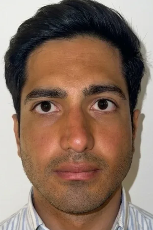 Resultat keratopigmentation avant