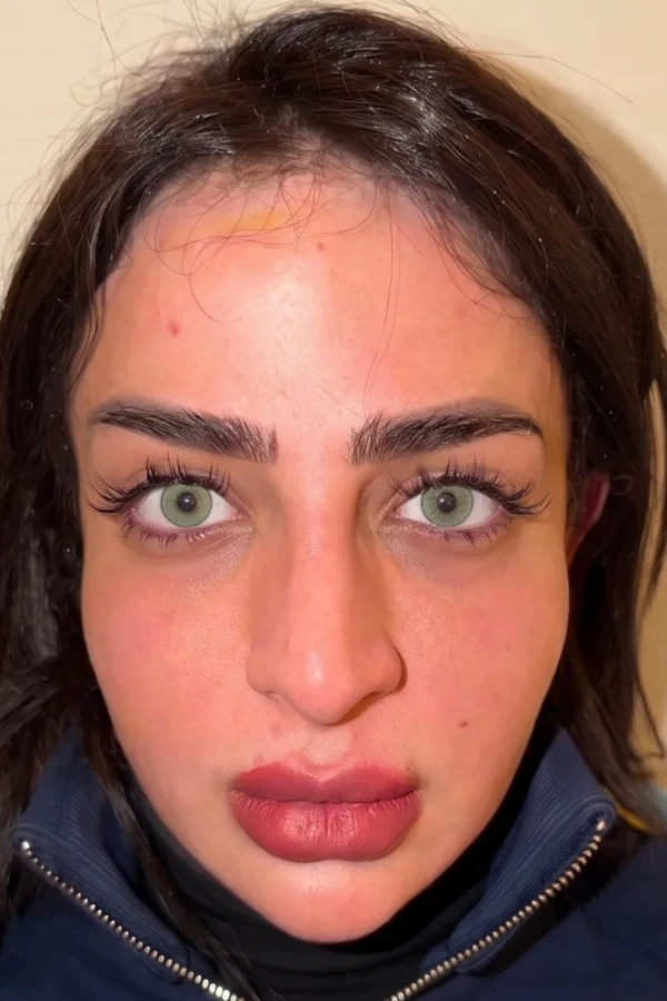 Resultat keratopigmentation apres