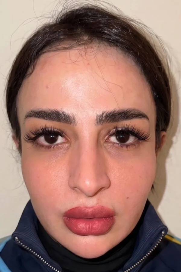 Resultat keratopigmentation avant