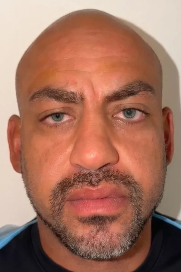 Kératopigmentation FLAAK - résultat après intervention, patient 