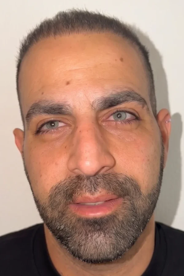 Kératopigmentation FLAAK - résultat après intervention, patient 