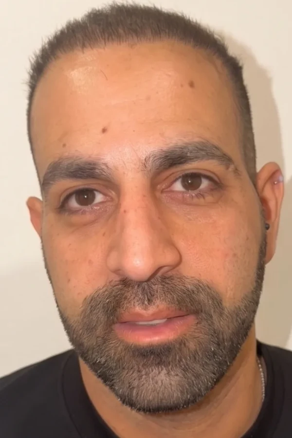 Kératopigmentation FLAAK - état avant intervention, patient 