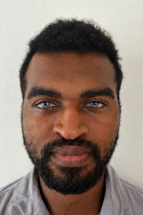Resultat keratopigmentation apres