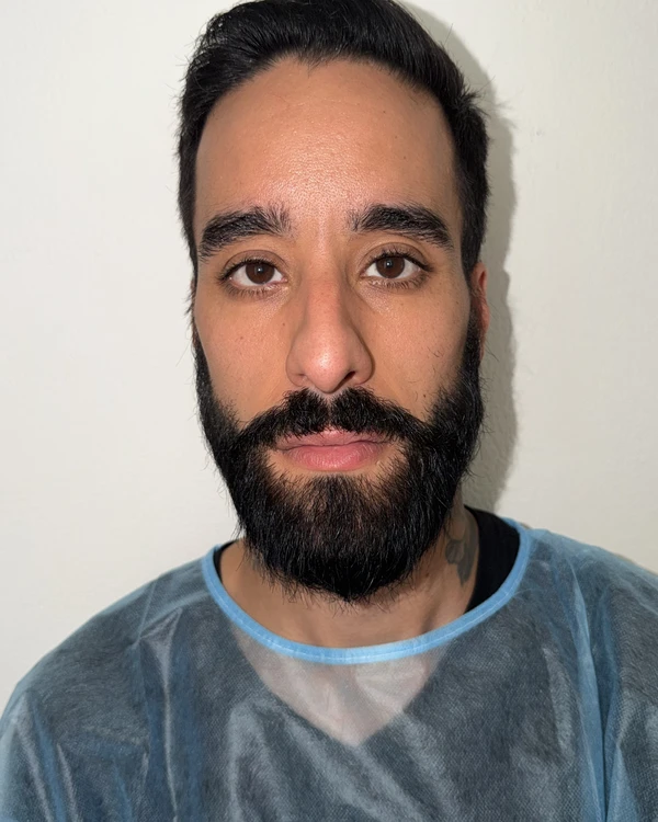 Resultat keratopigmentation avant