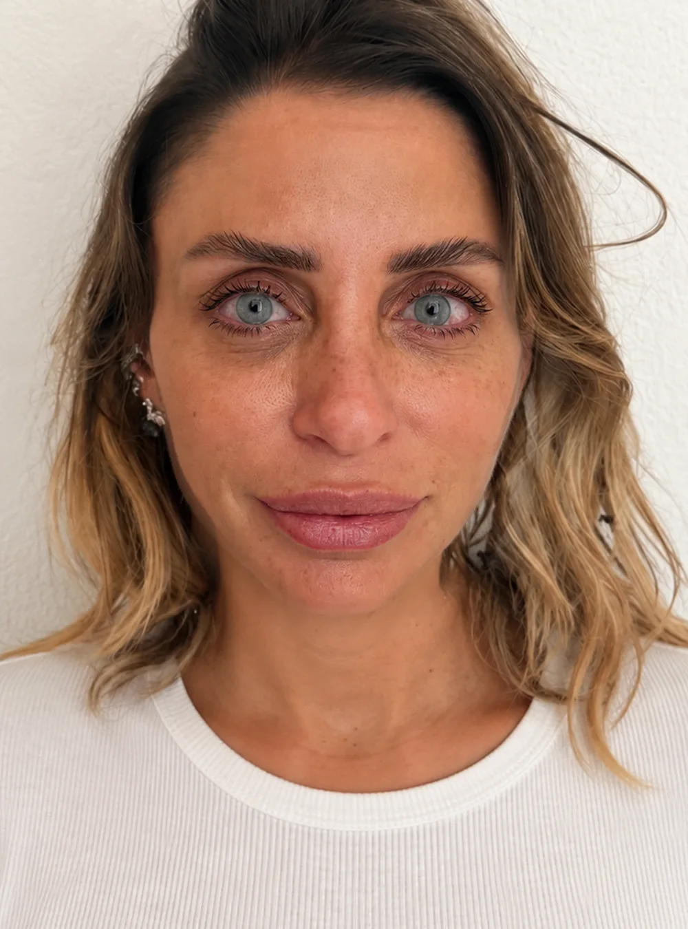 Ceratopigmentação FLAAK - resultado depois da cirurgia, paciente 27