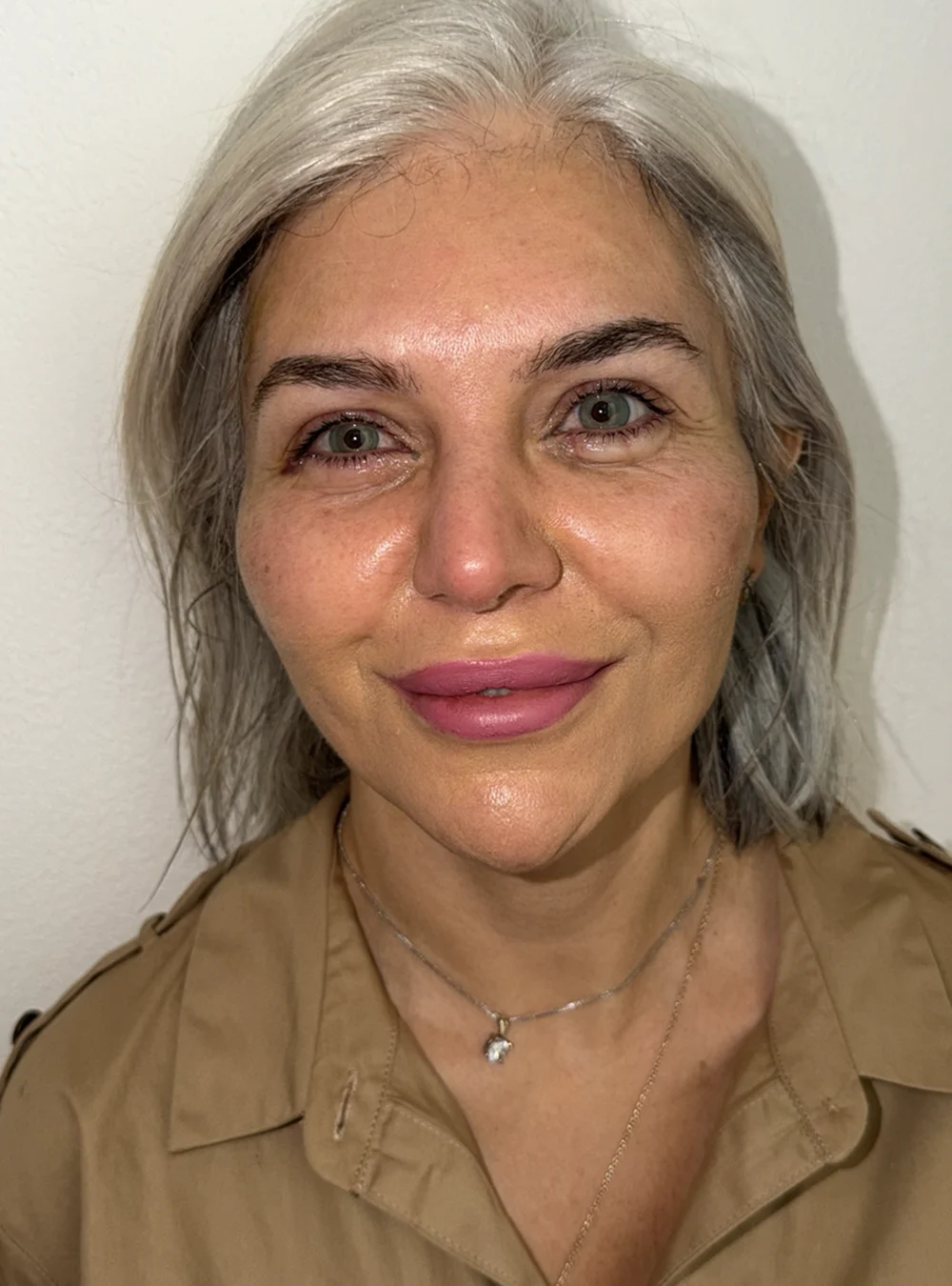 Ceratopigmentação FLAAK - resultado depois da cirurgia, paciente 31